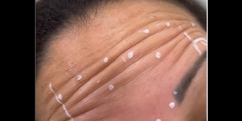 Harmonização Facial / Toxina Botulínica