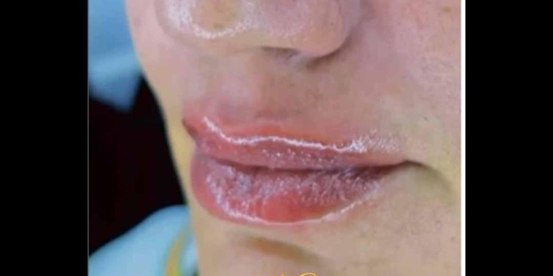 Preenchimento Labial