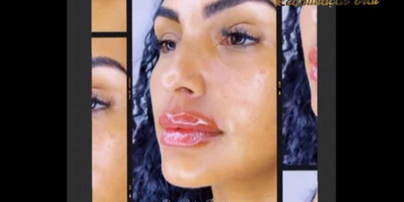 Preenchimento Labial