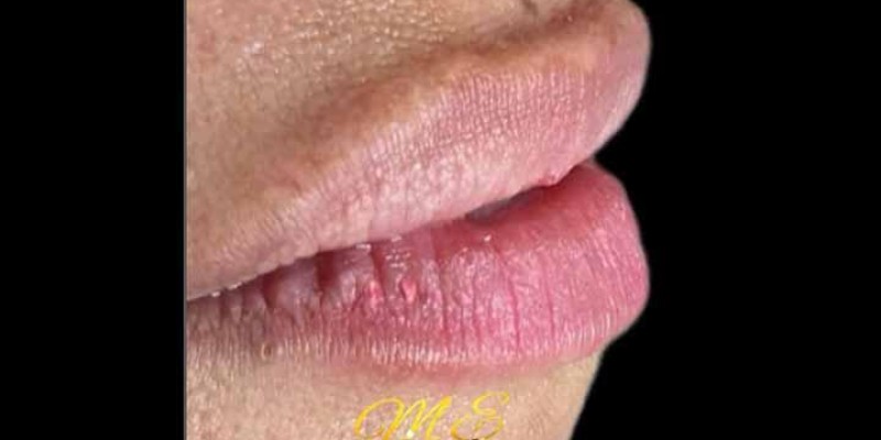 Preenchimento Labial