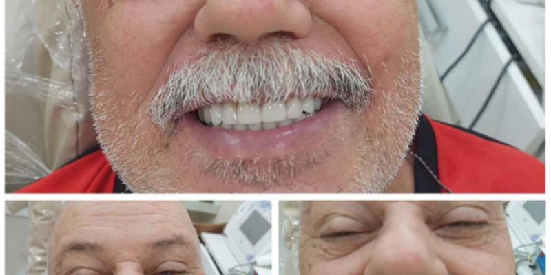 Tratamento de Implantes Dentário