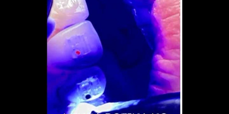 Tratamento Endodôntico, Harmonização Orafacial, Fios de PDO, Ácido Hialurônico