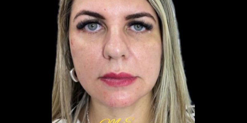 HARMONIZAÇÃO FACIAL