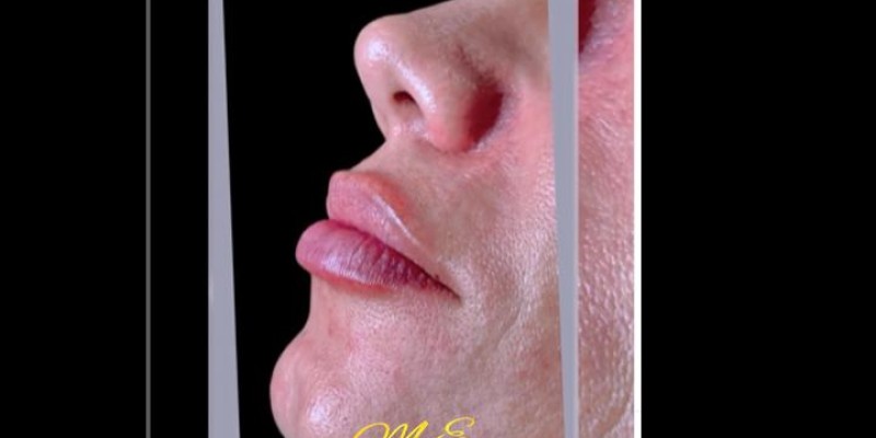 preenchimento labial