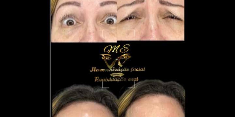 Tratamento de Botox