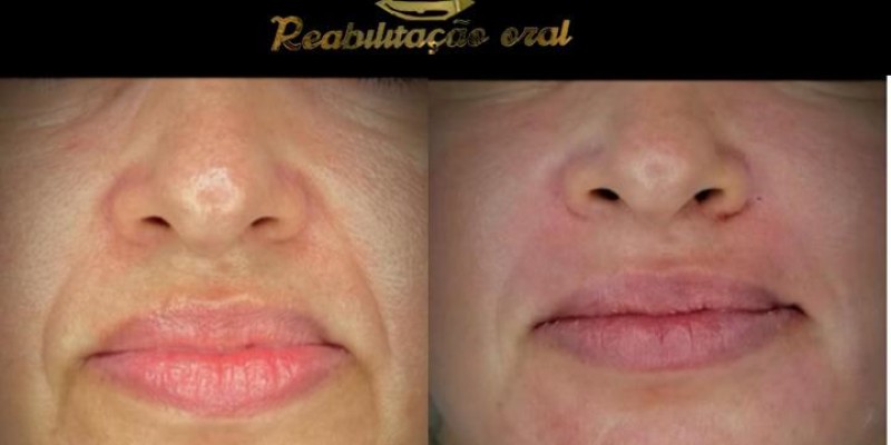 harmonização facial