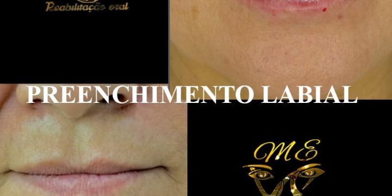 Tratamento Preenchimento Facial