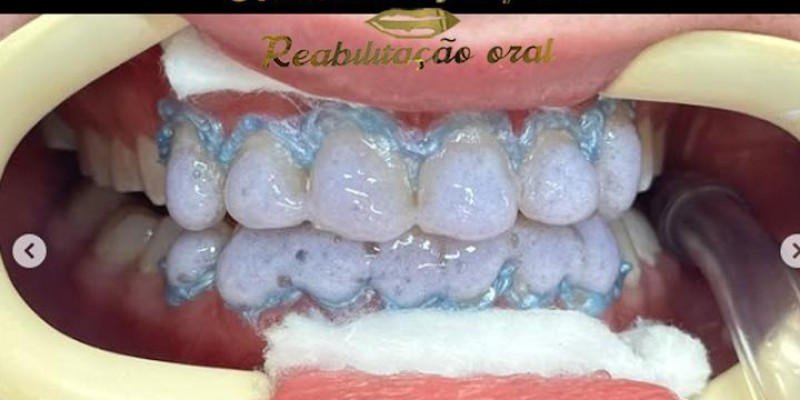 Clareamento Dentário