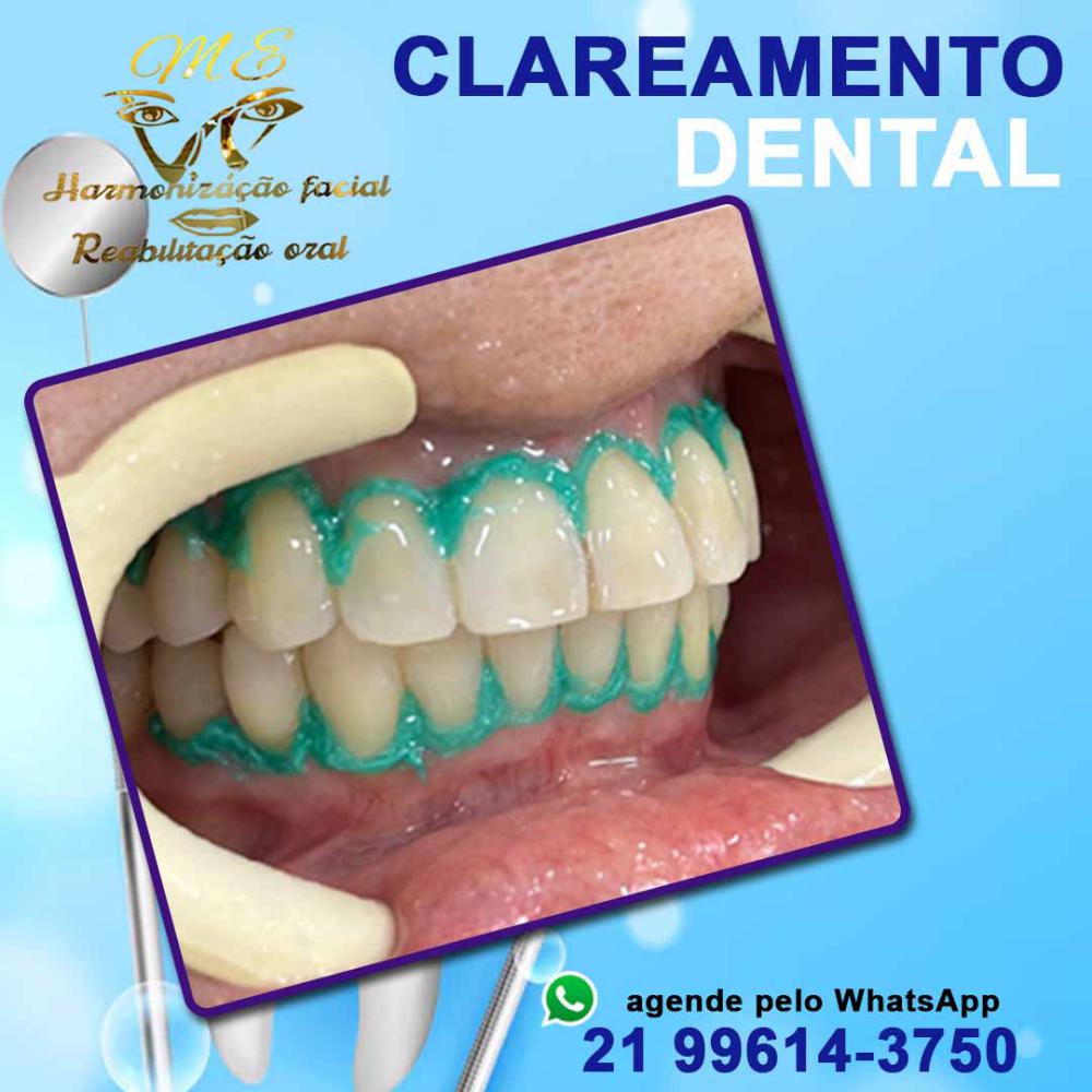 Clareamento Dental