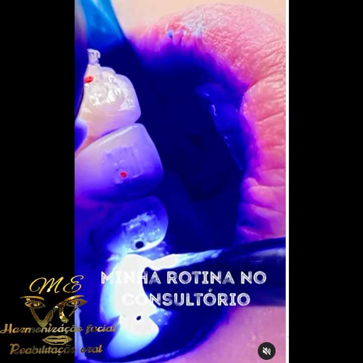 Tratamento Endodôntico, Harmonização Orafacial, Fios de PDO, Ácido Hialurônico