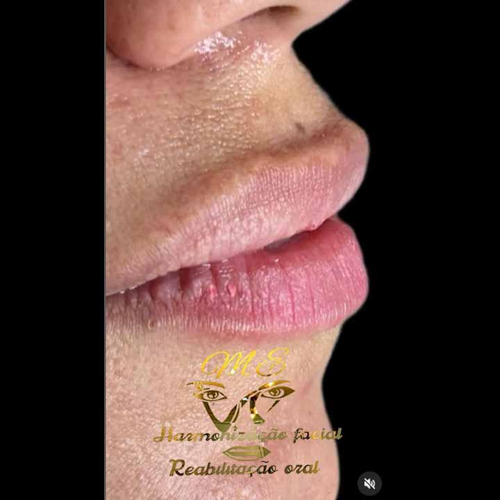 Preenchimento Labial