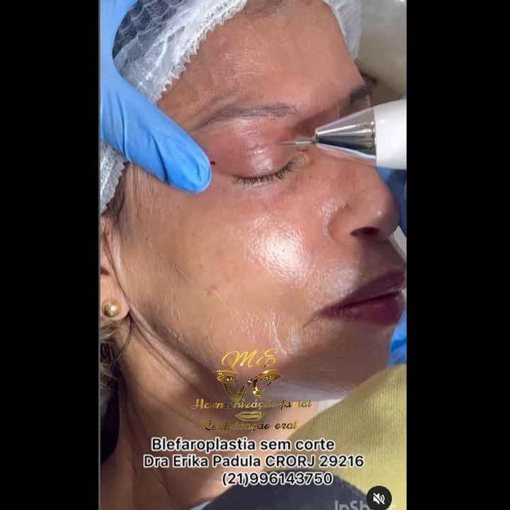HARMONIZAÇÃO FACIAL