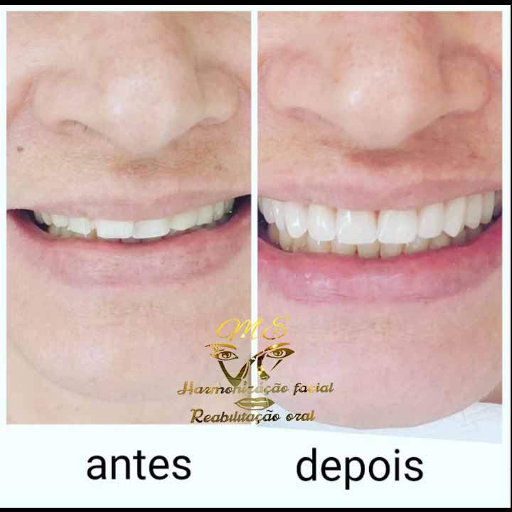 Mais um antes e depois do Tratamento de Implante Dentário