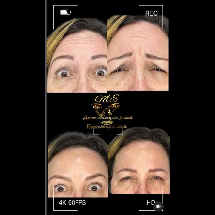 Tratamento de Botox